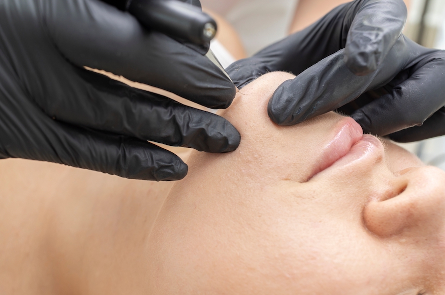 Electrolysis treatment for unwanted chin hair